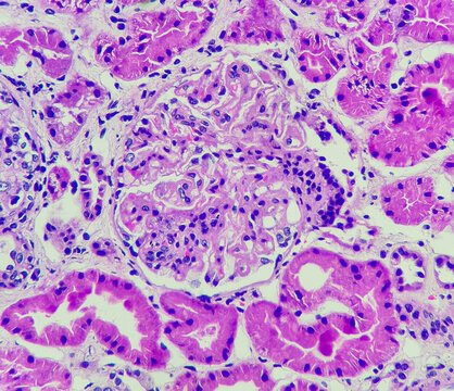 Photo of lupus nephritis, showing endocapillary hypercellularity, H&E stain, magnification 400x, photo under microscope