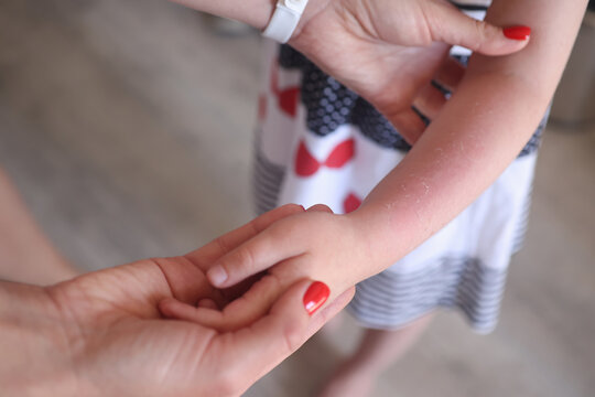 Sunburn redness and peeling of skin on child hand closeup