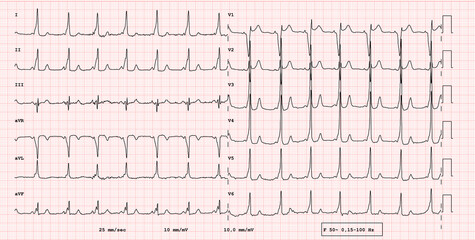 ECG example of a pathological 12-lead rhythm, ventricular pre-excitation syndrome