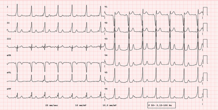 ECG example of a pathological 12-lead rhythm, ventricular pre-excitation syndrome