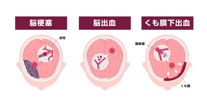 脳卒中 (脳梗塞・脳出血・くも膜下出血) の原因と症状　図解ベクターイラスト