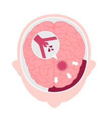 Types of human brain stroke vector illustration | Subarachnoid hemorrhage