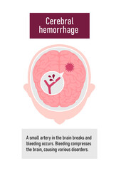 Types of human brain stroke vector illustration | Cerebral hemorrhage