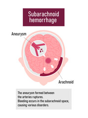 Fototapeta premium Types of human brain stroke vector illustration | Subarachnoid hemorrhage