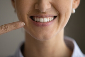 Close up happy young woman pointing finger on toothy smile, feeling satisfied with professional...