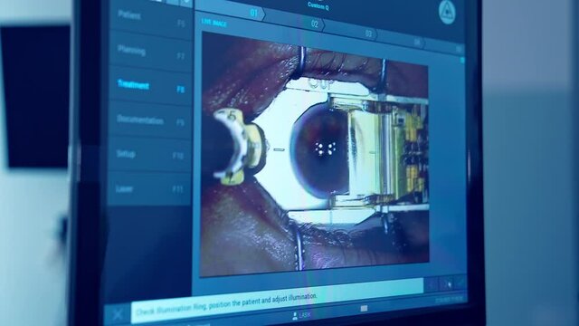 Laser eye treatment on a screen of a monitor. Computer monitor with eye surgery. Ophthalmological procedure of eye correction in clinic. Close-up.