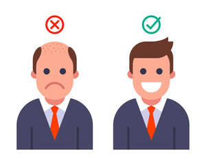bald man transplanted hair. result before and after hair transplant. flat vector illustration.