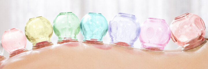Vacuum cupping therapy. Close up detail of glass suction cups applied to patient's back. Web banner.
