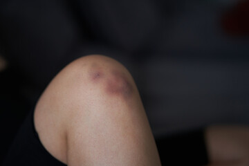 Close-up of a person massaging an injured knee joint. Bruise on the knee. Leg pain