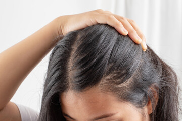 Women allergic to shampoo causing hair loss, baldness, dandruff - obrazy, fototapety, plakaty