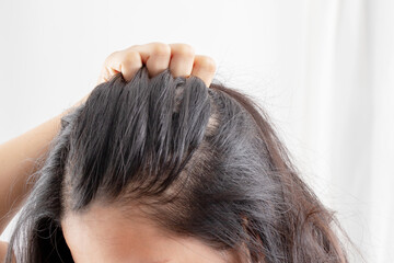 Women allergic to shampoo causing hair loss, baldness, dandruff