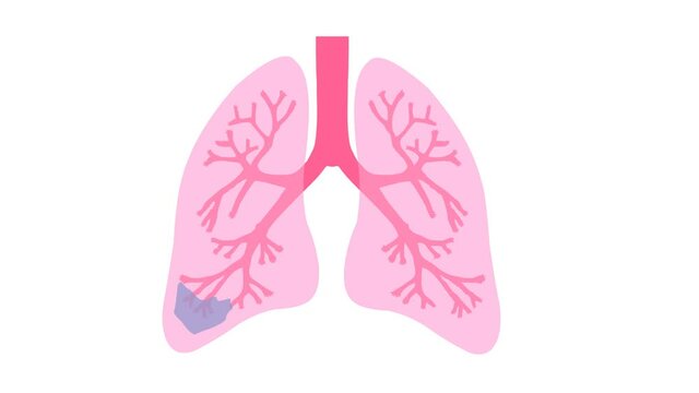 Animation of lungs of a person and breathing (or ventilation) of a healthy and diseased lung. White background and transparent with alpha channel. Infecting a lung and recovering from pneumonia.