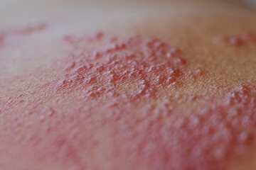 Skin diseases caused by viral infections,shingles