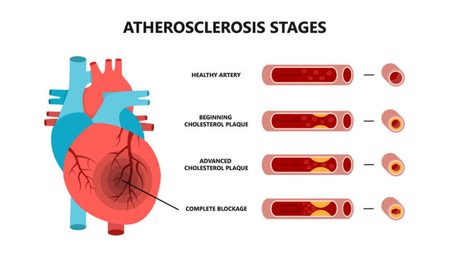 Heart attack and atherosclerosis stages. Healthy artery, beginning cholesterol plaque, advanced cholesterol plaque, complete blockage.
