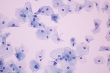 View in microscopic of Abnormal human cervix cells.Squamous epithelium cells.Superficial and...