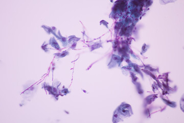 View in microscopic of Candidiasis, fungus infection (Yeast and Pseudohyphae form) in pap smear...