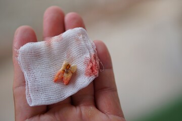 Close-up pulled decay tooth on white gauze pap with blood stain on hand. Selective focus on tooth....