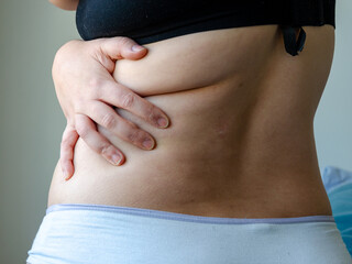 white woman showing her back with fat, adiposity, obesity, real body