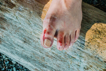Man's bleeding bare feet after being cut by sharp rocks at an ocean beach
