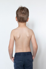 A little boy with a special orthopedic posture corrector on the back to adjust, align the back, posture. Rear view. Copy space