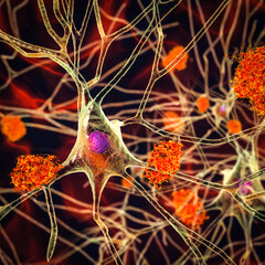Neurons in Alzheimer's disease. 3D illustration - obrazy, fototapety, plakaty