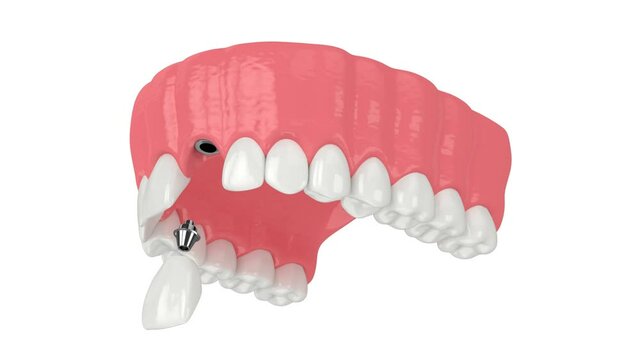Upper jaw with dental implant installation over white background