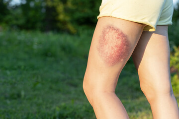 female leg with large bruise. woman with hematoma on the thigh. copy space, text