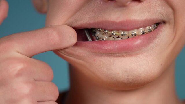 Closeup view 4k video footage of metal spring inside of mouth of teenage young kid as part of orthodontic metal constractions of braces (brackets). Jaws extension treatment for making perfect bite