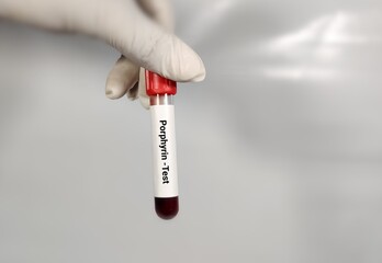 Obraz premium Test Tube with blood sample for Porphyrin test, neurologic porphyria. A medical testing concept in the laboratory background.