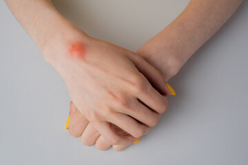 Ganglion cyst on woman hand on white background