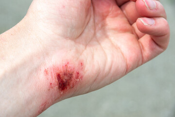 Bloody wound on the palm, arm, wrist after an accident or fall. First aid in wound treatment. Treatment of wounds