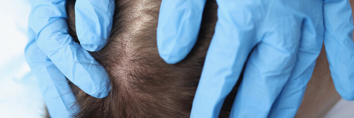 Doctor in protective gloves examining skin on patients head closeup