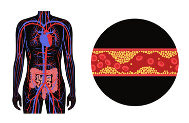 Mesentric ishemia disease