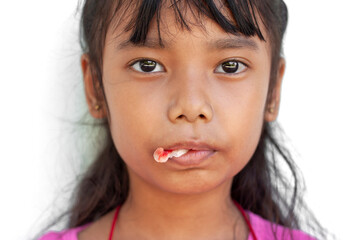 Closeup Asian little girl biting the gauze in mount to stop the bleeding after the extraction of...