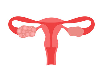 Polycystic ovary syndrome PCOS of woman. Female reproductive system disease. Abnormal uterus internal organ. Vector illustration - obrazy, fototapety, plakaty