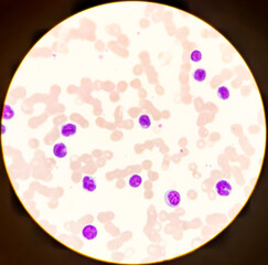 Blood picture of acute myeloid leukemia (AML),The smear shows large number of cancer leukemia cells,microscopic view