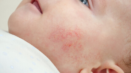 Closeup of baby face with red skin suffering from acne and dermatitis. Concept of newborn baby...