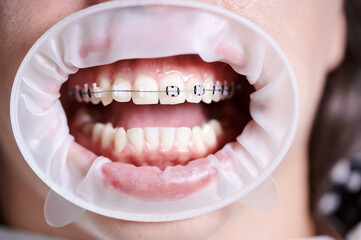 Close up of patient with cheek retractor in mouth demonstrating dental braces on white teeth. Woman...