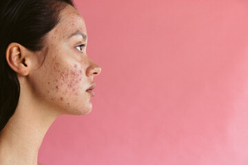 Skin disorders may lead to low self esteem in women