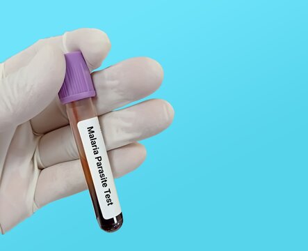 Test Tube with blood sample for Malaria Parasite test. Diagnosis for malaria fever. Test in the laboratory background.