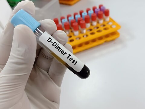 Lab Technologist holds Blood samples for D Dimer test. Corona patient monitoring test in ICU. Close view. Deep venous thrombosis. Iintra vascular coagulation. Aortic dissection.