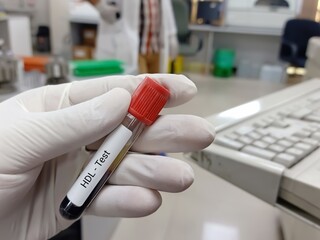 Biochemist or Lab Technologist holds Blood sample for HDL (High-density lipoprotein) test. Lipid profile. Good Cholesterol. Medical testing concept.