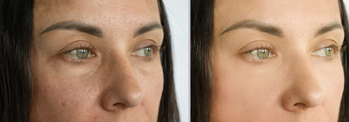 woman eyes wrinkles before and after treatment