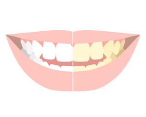 ホワイトニング_歯の着色の比較
