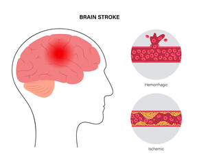 Brain stroke ishemic and hemorrhagic