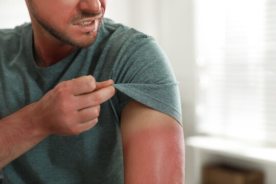 Man with sunburned skin at home, closeup