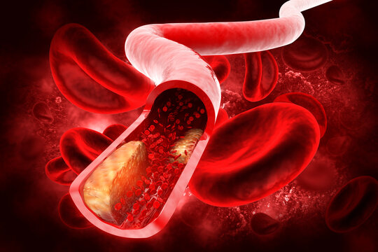Cholesterol plaque in artery.3d illustration