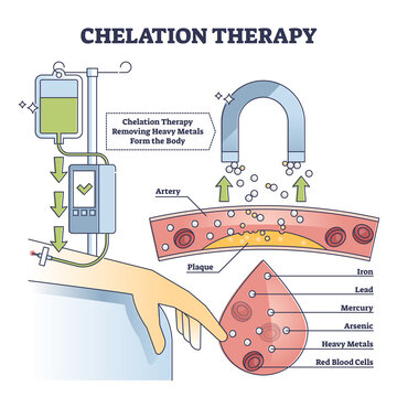 Chelation therapy for toxic heavy metal medical treatment outline diagram. Anatomical bloodstream injection in artery to remove minerals from body vector illustration. Intravenous plaque care scheme.