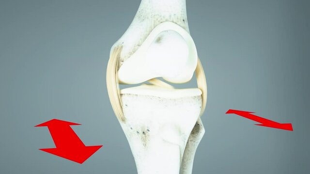 Knee ligament rupture, cruciate ligament rupture, joint instability in different directions, knee joint,  knee anatomy, knee surgery, meniscus, hip, 3D render of human anatomy