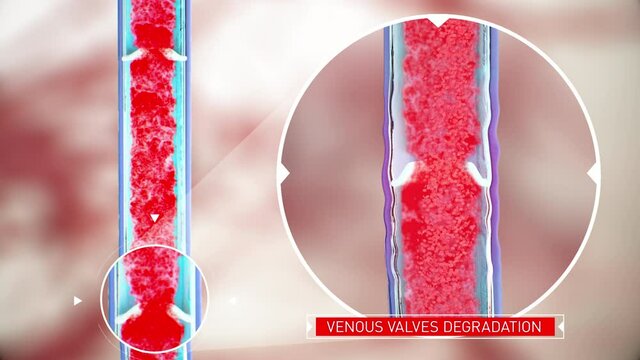 Venous Valve Dysfunction, Degradation Of The Vein Walls, Impaired Blood Flow, Leg Vein Anatomy, Erythrocytes, Human Anatomy, 3d Render